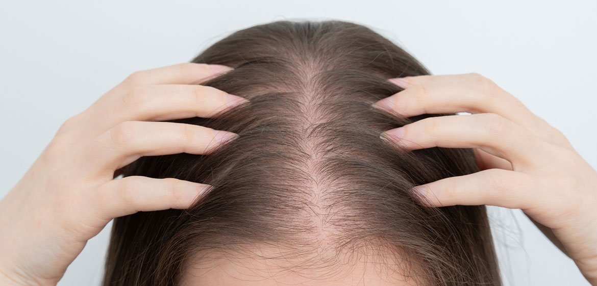 Nahaufnahme von der Kopfhaut einer Frau mit Haarausfall